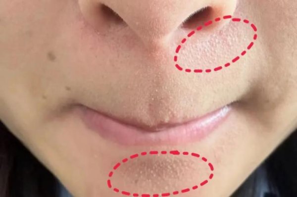 公牛配资 真的想问：下巴凸起的小颗粒，到底是什么呀？